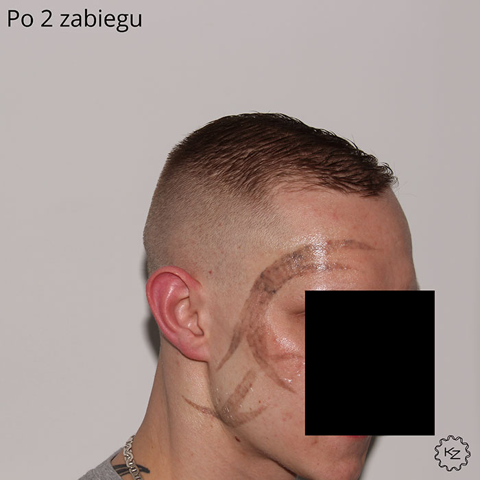 usuwanie tatuażu katowice